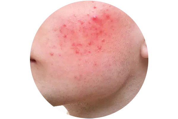 Rosacea