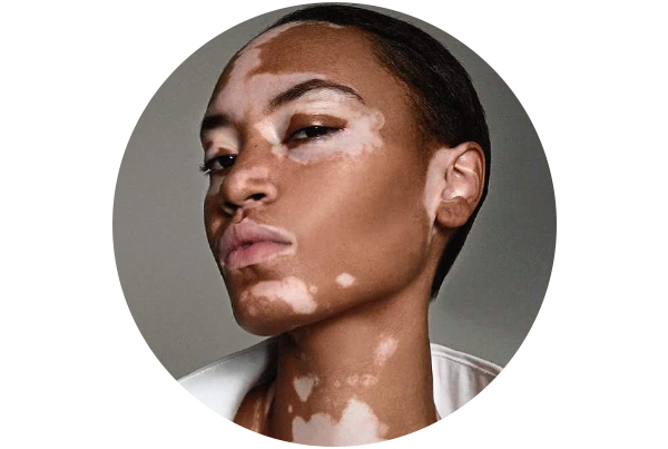 Leucoderma / Vitiligo