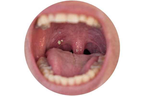 Tonsil Stones