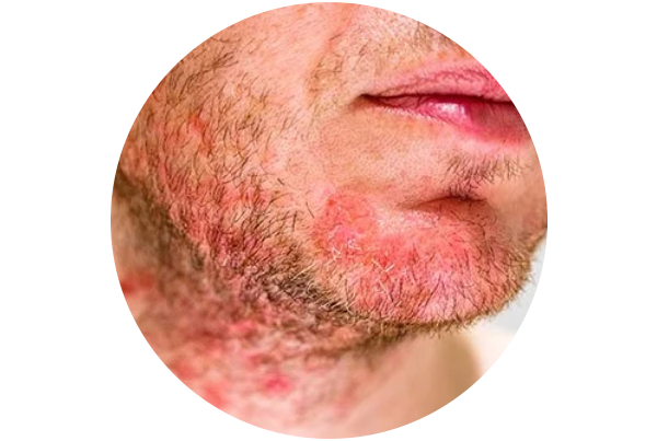 Folliculitis