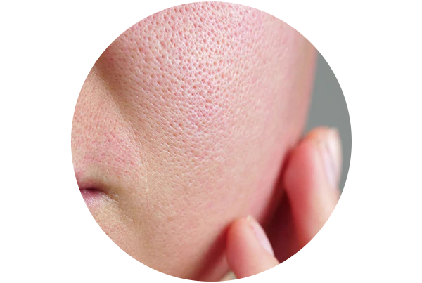 Open Pores