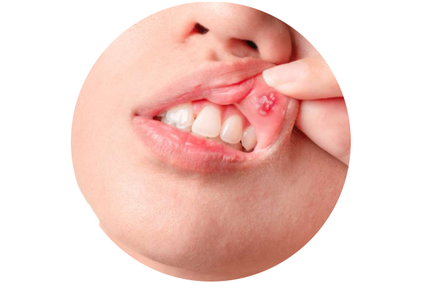 Mouth Ulcer