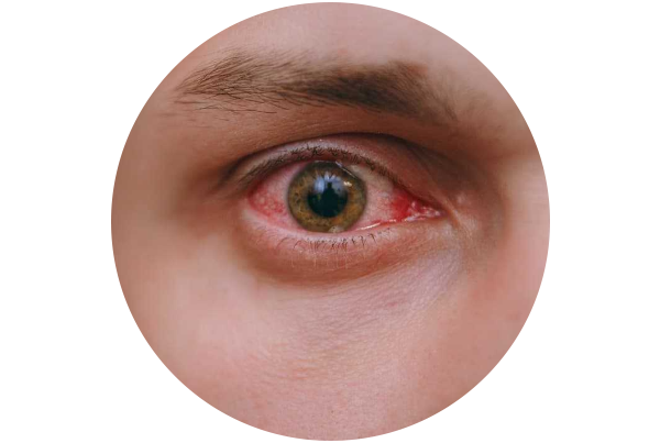 Conjunctivitis