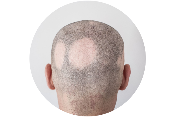 Baldness / Alopecia Areata